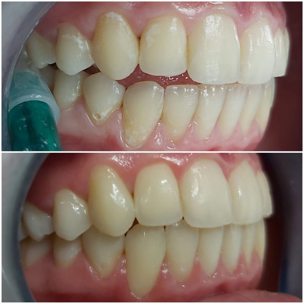 copia de retirada manchas con técnica microabrasión dra. bozhana