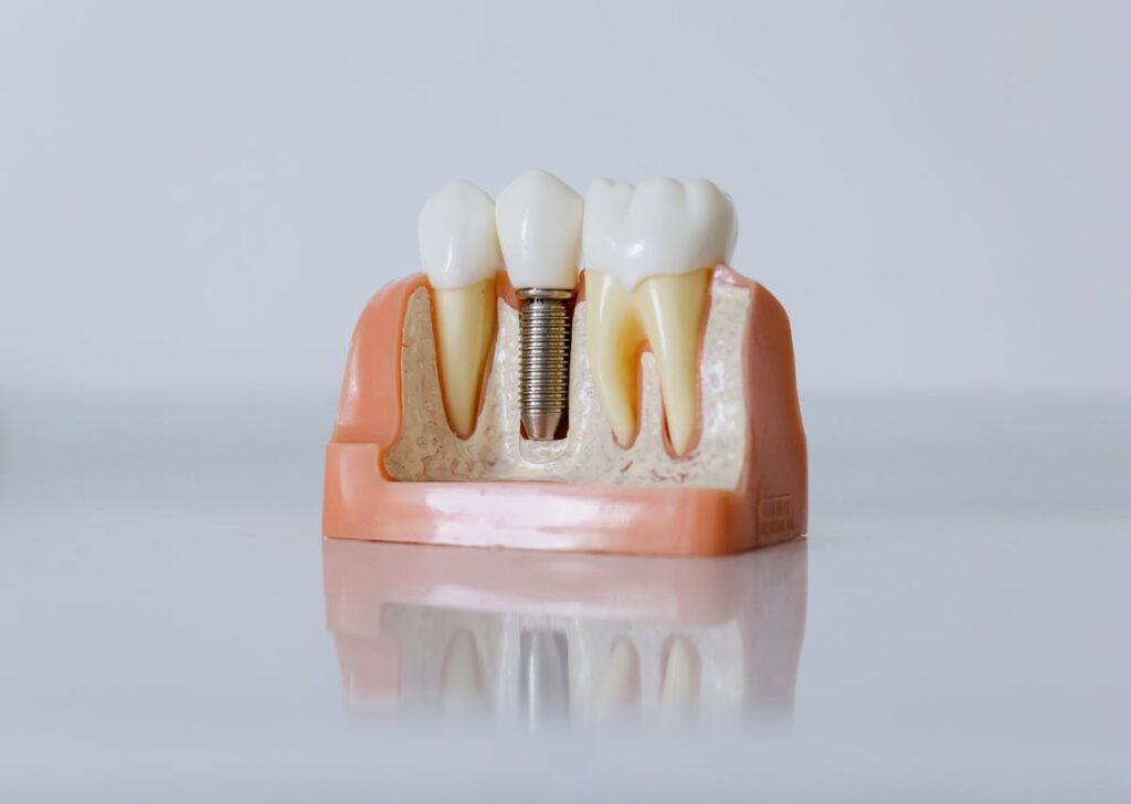 implant dental
